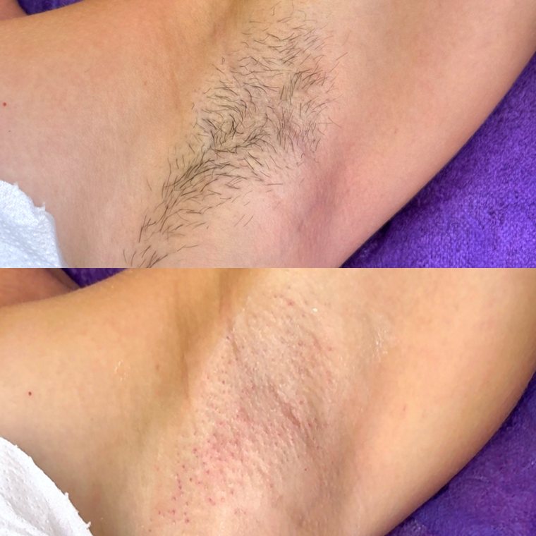 Underarm wax before and after