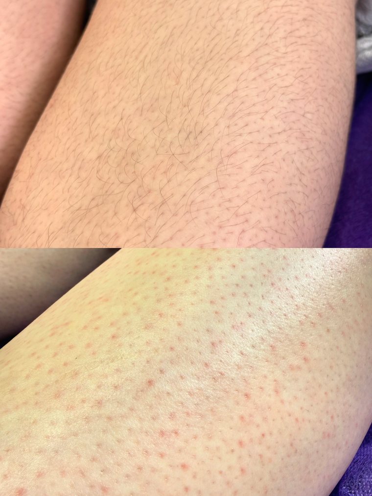 Leg wax before and after