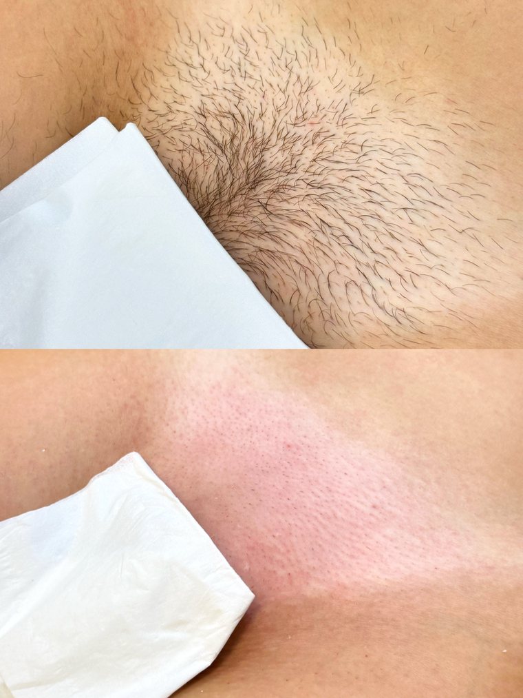 Bikini wax before and after